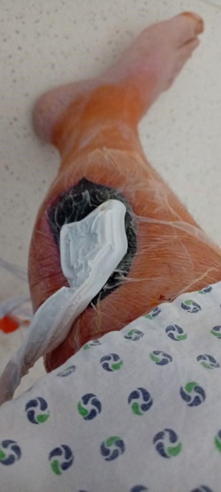 Так сейчас смотрится нога Натальи.