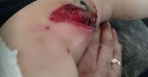 Раненая ножка дочери Натальи Варвары