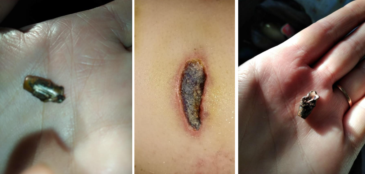 Куля та поранення. Фото: Тетяна Овчаренко