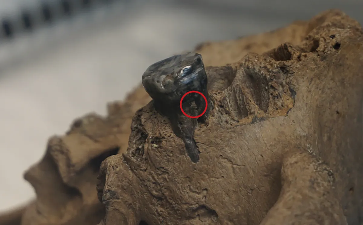 Мітохондріальну ДНК вдалося взяти із зубного каменю, що утворився на зубі черепа 