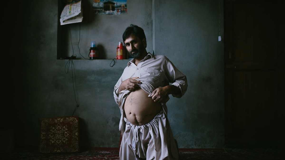 Автор Zacharie Rabehi. На снимке - мужчина из Паттана, пострадавший от жестоких пыток в ходе Кашмирского конфликта