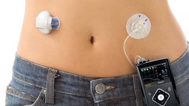 Искусственная поджелудочная железа